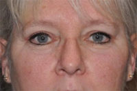 Upper Eyelid Lift or Blepharoplasty