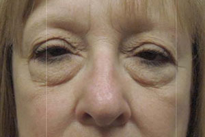 Upper Eyelid Lift or Blepharoplasty