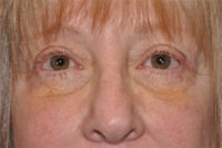 Upper Eyelid Lift or Blepharoplasty