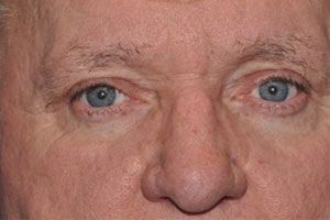 Upper Eyelid Lift or Blepharoplasty