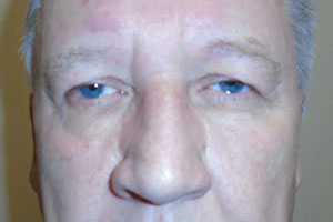 Upper Eyelid Lift or Blepharoplasty