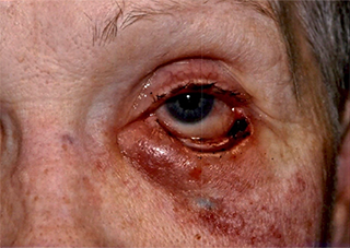 Post Cancer Repair Case 727 Before Photo Post Cancer Repair