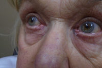 Eyelid Lesion