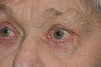 Eyelid Lesion