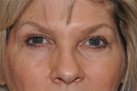 Lower Eyelid Lift or Blepharoplasty