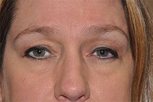 Eyebrow Lift or Forehead Lift