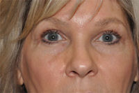 Lower Eyelid Lift or Blepharoplasty