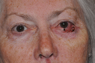 Lower Eyelid Lift or Blepharoplasty