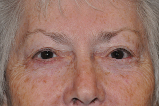 Lower Eyelid Lift or Blepharoplasty