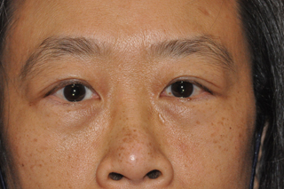 Lower Eyelid Lift or Blepharoplasty