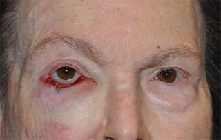 Post Cancer Repair Case 1442 Before Photo Post Cancer Repair