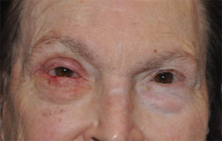 Post Cancer Repair Case 1442 After Photo Post Cancer Repair
