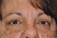 Eyelid Lesion