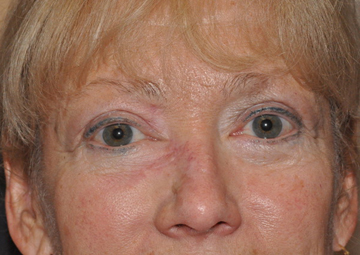 Eyelid Lesion