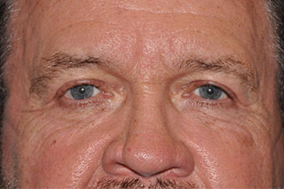 Droopy Upper Eyelids (Ptosis)