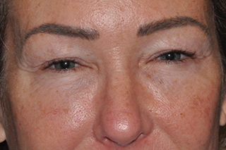 Upper Eyelid Lift or Blepharoplasty