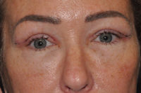 Upper Eyelid Lift Before & After Results Michigan