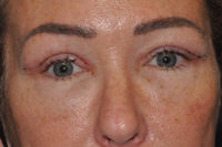 Upper Eyelid Lift or Blepharoplasty