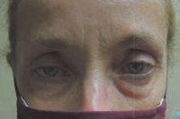 Droopy Upper Eyelids (Ptosis)