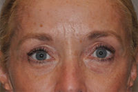 Droopy Upper Eyelids (Ptosis)