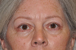 Droopy Upper Eyelids (Ptosis)