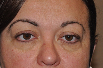 Droopy Upper Eyelids (Ptosis)