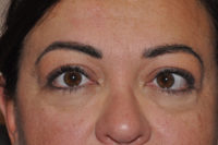 Droopy Upper Eyelids (Ptosis)