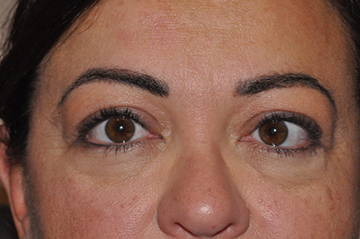 Droopy Upper Eyelids (Ptosis)