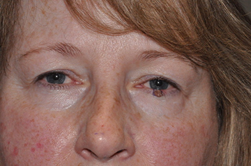 Eyelid Lesion