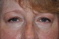 Eyelid Lesion