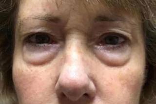 Lower Eyelid Lift or Blepharoplasty