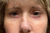 Lower Eyelid Lift or Blepharoplasty