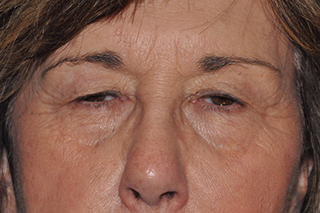 Eyebrow Lift or Forehead Lift