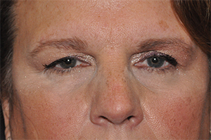 Droopy Upper Eyelids (Ptosis)