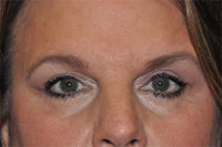 Droopy Upper Eyelids (Ptosis)