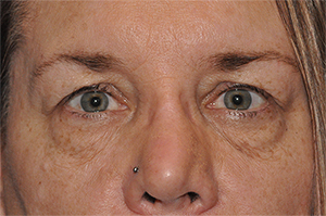 Lower Eyelid Lift or Blepharoplasty