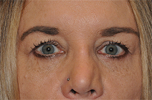 Lower Eyelid Lift or Blepharoplasty