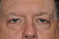 Droopy Upper Eyelids (Ptosis)