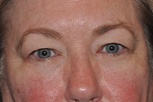 Lower Eyelid Lift or Blepharoplasty