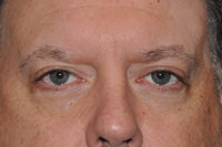 Droopy Upper Eyelids (Ptosis)