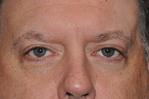 Droopy Upper Eyelids (Ptosis)