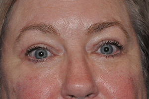 Lower Eyelid Lift or Blepharoplasty