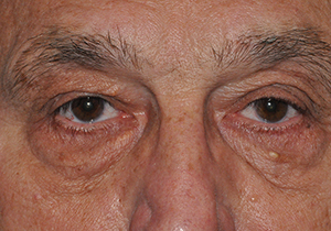 Droopy Upper Eyelids (Ptosis)