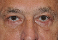 Droopy Upper Eyelids (Ptosis)