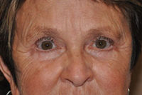 Droopy Upper Eyelids (Ptosis)