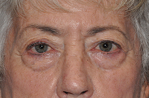 Droopy Upper Eyelids (Ptosis)