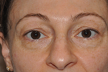 Lower Eyelid Lift or Blepharoplasty