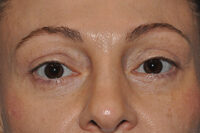 Lower Eyelid Lift or Blepharoplasty