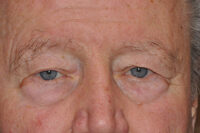 Droopy Upper Eyelids (Ptosis)