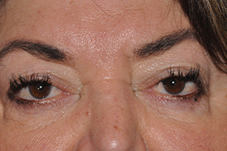 Droopy Upper Eyelids (Ptosis)